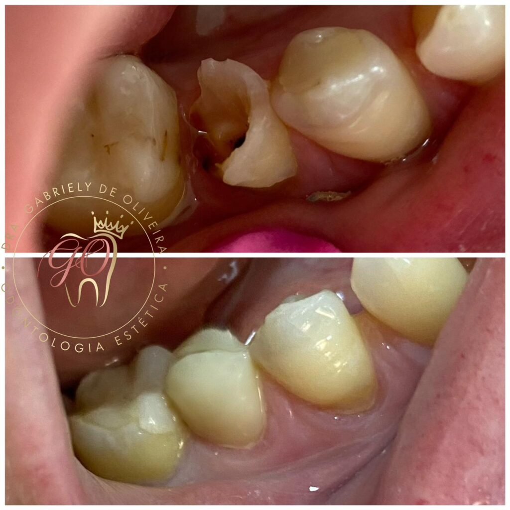 restauração de dente guarulhos, dentista urgente guarulhos, sos dentista