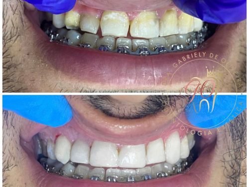 Dentista aparelho guarulhos manutencção