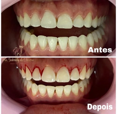 Antes e depois de tratamento para a saúde da gengiva